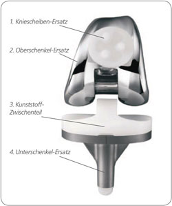 Übersicht Knieprothese