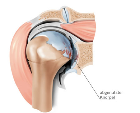 Schultergelenkarthrose